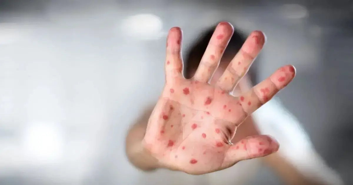 Imagen referencial de sarampión