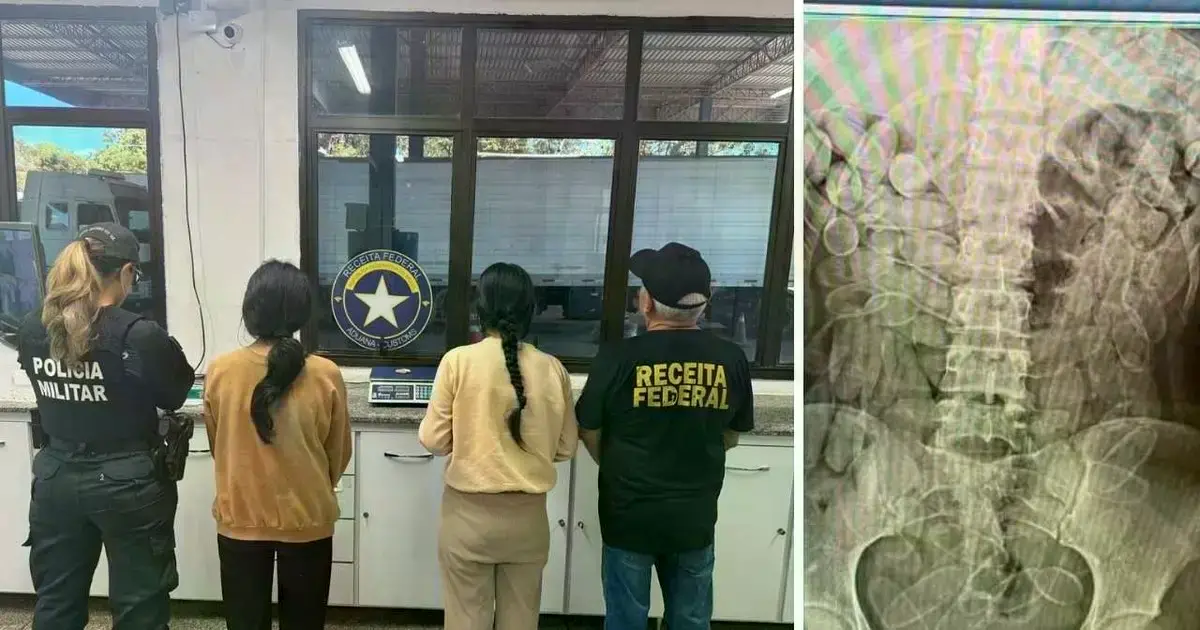 Radiografía que muestra cápsulas de droga en el organismo de una de las detenidas.