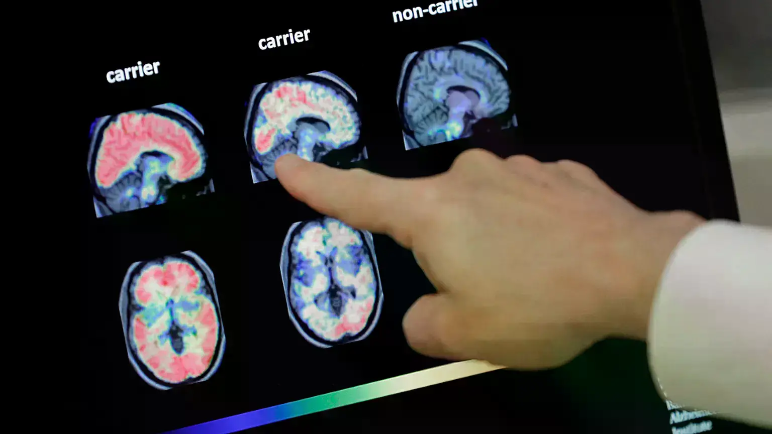Un médico observa imágenes cerebrales de tomografía por emisión de positrones (PET) en el Benner Alzheimer's Institute de Pho