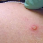 Bolivia confirma diez casos de viruela del mono en lo que va de año